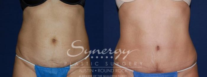 Before & After Abdominoplasty (Tummy Tuck) Case 81 View #3 View in Austin, TX