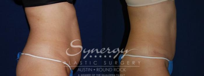 Before & After Abdominoplasty (Tummy Tuck) Case 81 View #4 View in Austin, TX