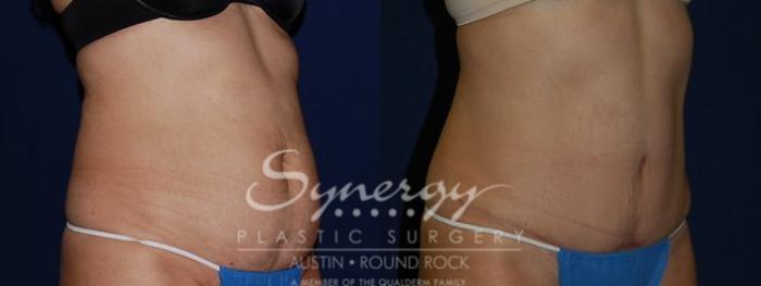 Before & After Abdominoplasty (Tummy Tuck) Case 81 View #5 View in Austin, TX
