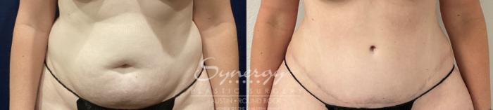 Before & After Abdominoplasty (Tummy Tuck) Case 862 Front View in Austin, TX