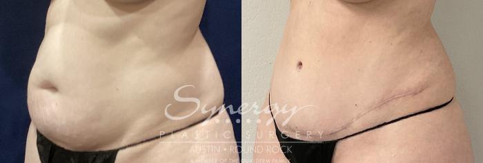 Before & After Abdominoplasty (Tummy Tuck) Case 862 Left Oblique View in Austin, TX