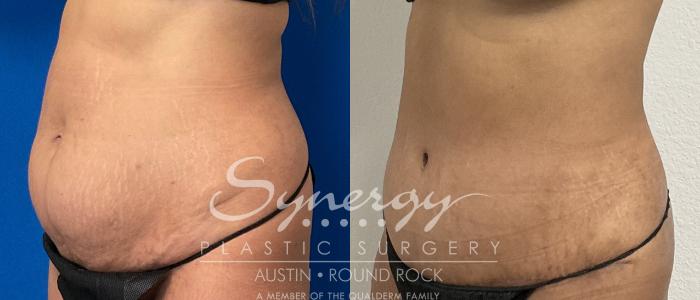 Before & After Abdominoplasty (Tummy Tuck) Case 868 Left Oblique View in Austin, TX