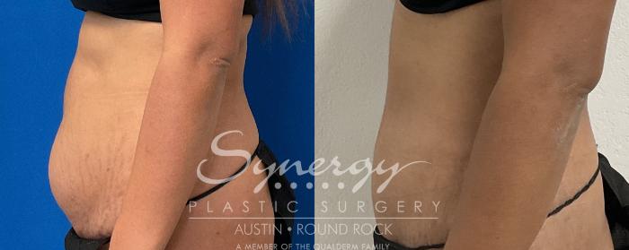 Before & After Abdominoplasty (Tummy Tuck) Case 868 Right Side View in Austin, TX