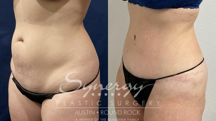 Before & After Abdominoplasty (Tummy Tuck) Case 871 Left Oblique View in Austin, TX
