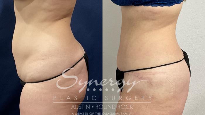 Before & After Abdominoplasty (Tummy Tuck) Case 871 Left Side View in Austin, TX
