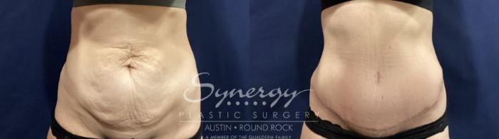 Before & After Abdominoplasty (Tummy Tuck) Case 881 Front View in Austin, TX