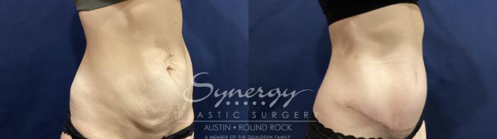 Before & After Abdominoplasty (Tummy Tuck) Case 881 Left Oblique View in Austin, TX
