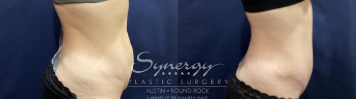 Before & After Abdominoplasty (Tummy Tuck) Case 881 Left Side View in Austin, TX