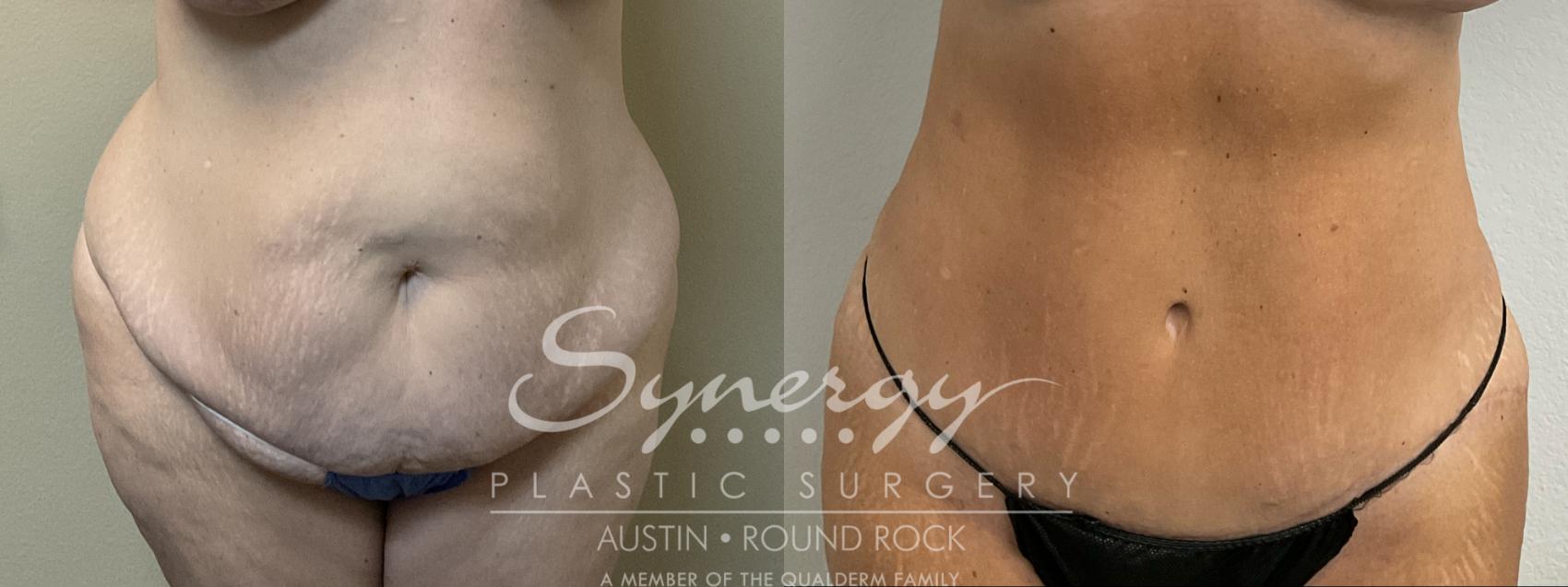 Before & After Abdominoplasty (Tummy Tuck) Case 901 Front View in Austin, TX