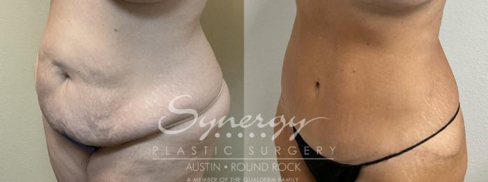 Before & After Abdominoplasty (Tummy Tuck) Case 901 Left Oblique View in Austin, TX