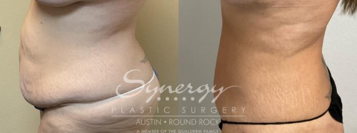 Before & After Abdominoplasty (Tummy Tuck) Case 901 Left Side View in Austin, TX