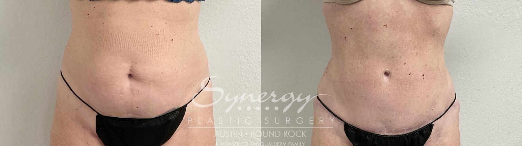 Before & After Abdominoplasty (Tummy Tuck) Case 907 Front View in Austin, TX