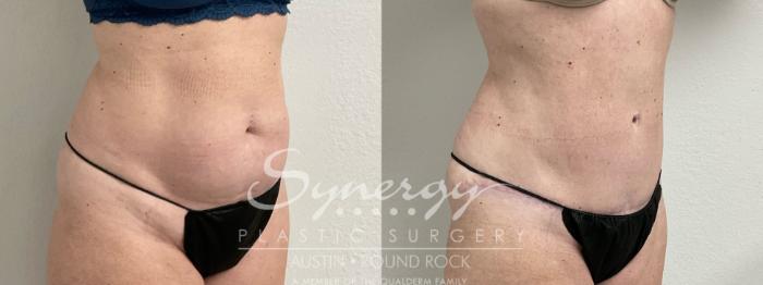 Before & After Abdominoplasty (Tummy Tuck) Case 907 Right Oblique View in Austin, TX