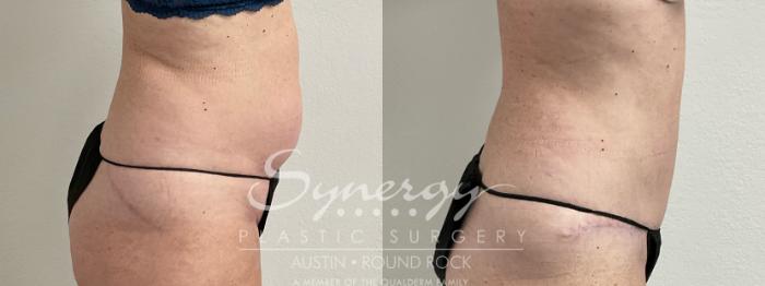 Before & After Abdominoplasty (Tummy Tuck) Case 907 Right Side View in Austin, TX