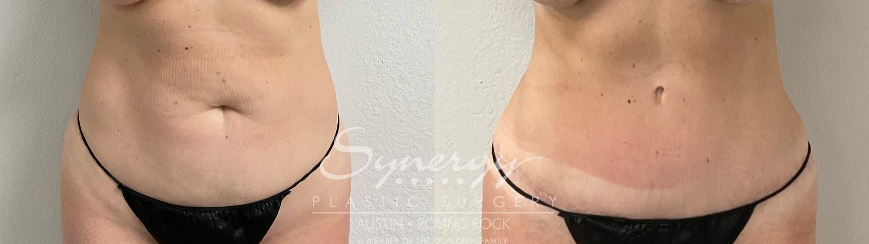 Before & After Abdominoplasty (Tummy Tuck) Case 913 Front View in Austin, TX