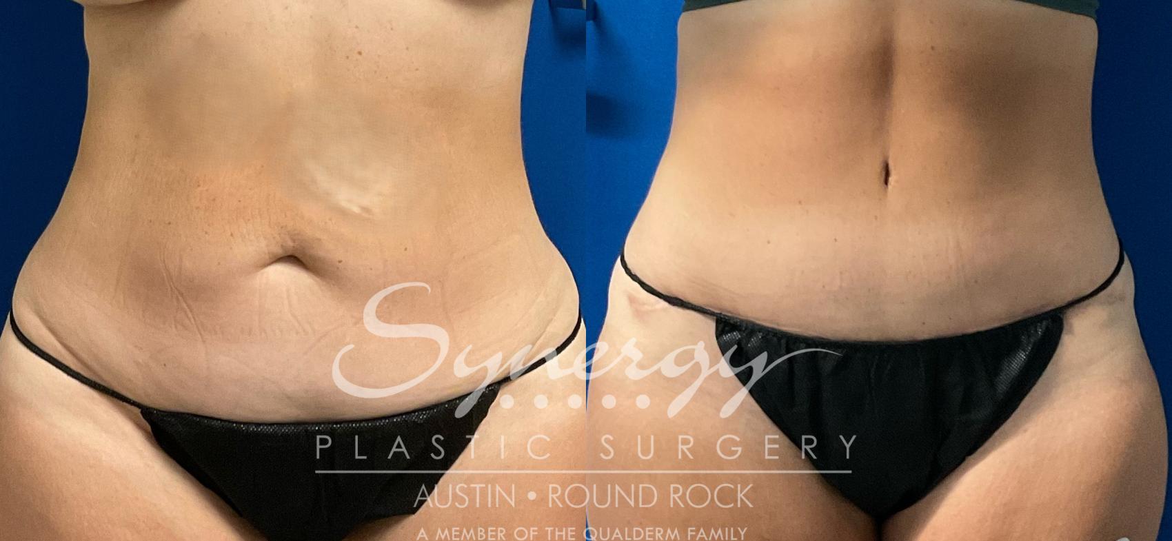 Before & After Abdominoplasty (Tummy Tuck) Case 932 Front View in Austin, TX