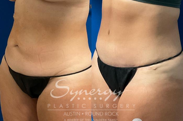 Before & After Abdominoplasty (Tummy Tuck) Case 932 Left Oblique View in Austin, TX