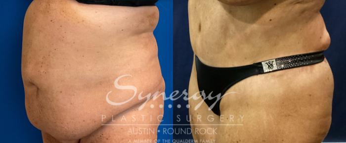 Before & After Abdominoplasty (Tummy Tuck) Case 937 Left Oblique View in Austin, TX