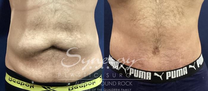 Before & After Abdominoplasty (Tummy Tuck) Case 938 Front View in Austin, TX
