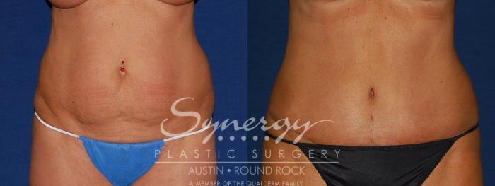 Before & After Abdominoplasty (Tummy Tuck) Case 95 View #1 View in Austin, TX