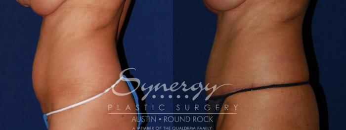 Before & After Abdominoplasty (Tummy Tuck) Case 95 View #2 View in Austin, TX