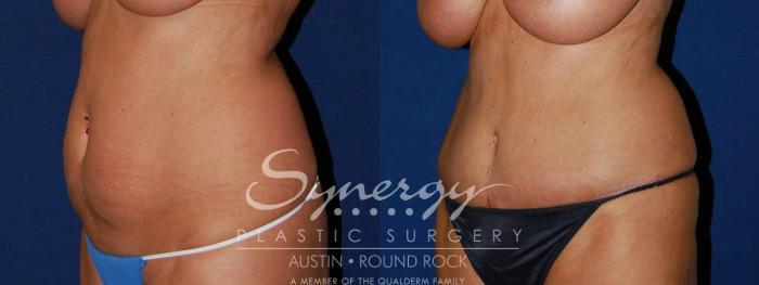 Before & After Abdominoplasty (Tummy Tuck) Case 95 View #3 View in Austin, TX