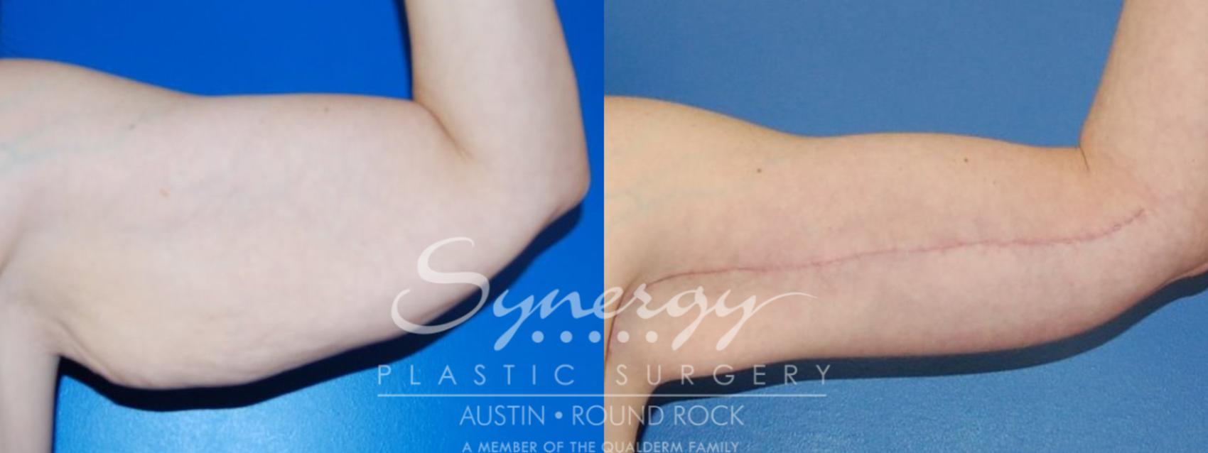 Before & After Arm Lift (Brachioplasty) Case 24 View #1 View in Austin, TX