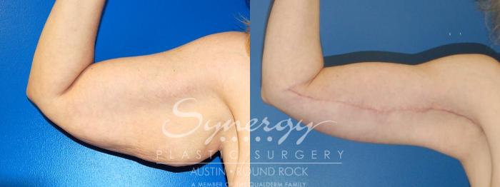 Before & After Arm Lift (Brachioplasty) Case 24 View #2 View in Austin, TX