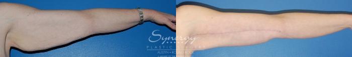 Before & After Arm Lift (Brachioplasty) Case 24 View #3 View in Austin, TX