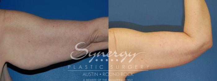 Before & After Arm Lift (Brachioplasty) Case 24 View #4 View in Austin, TX