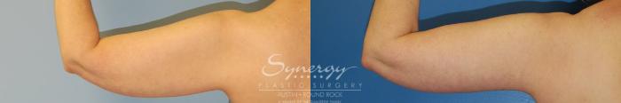 Before & After Arm Lift (Brachioplasty) Case 38 View #1 View in Austin, TX