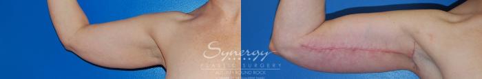 Before & After Arm Lift (Brachioplasty) Case 38 View #2 View in Austin, TX