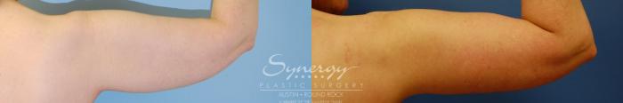 Before & After Arm Lift (Brachioplasty) Case 38 View #4 View in Austin, TX