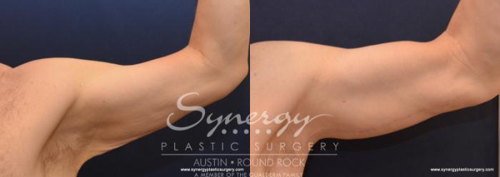 Before & After Arm Lift (Brachioplasty) Case 600 View #1 View in Austin, TX
