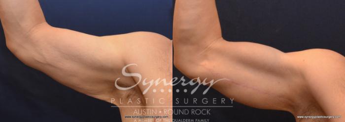 Before & After Arm Lift (Brachioplasty) Case 600 View #2 View in Austin, TX