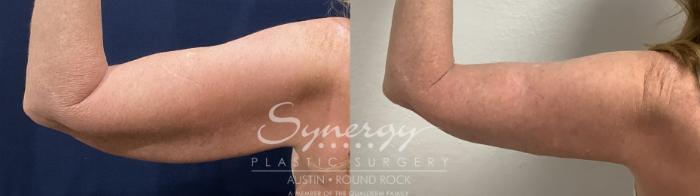 Before & After Arm Lift (Brachioplasty) Case 911 Back Left View in Austin, TX