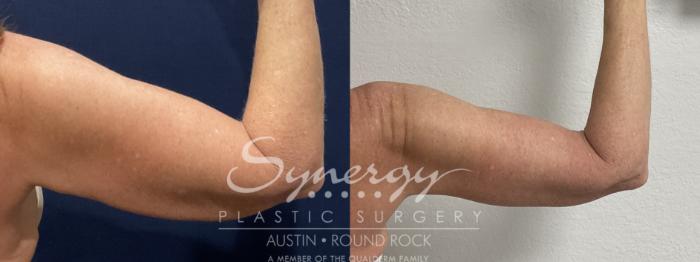 Before & After Arm Lift (Brachioplasty) Case 911 Back Right View in Austin, TX