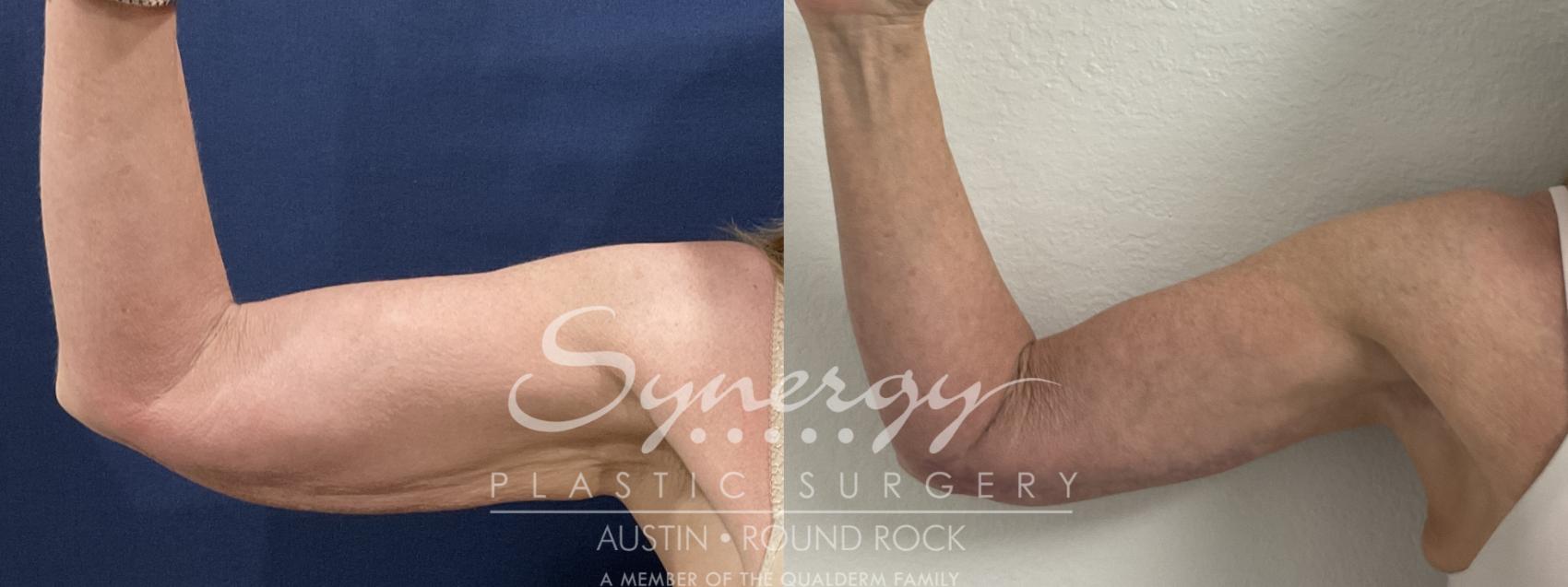 Before & After Arm Lift (Brachioplasty) Case 911 Front Right View in Austin, TX