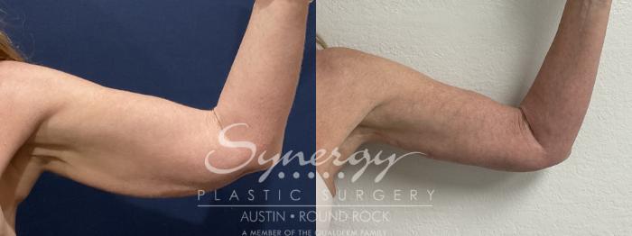 Before & After Arm Lift (Brachioplasty) Case 911 Right Left View in Austin, TX