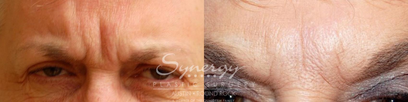 Before & After BOTOX® Cosmetic & Dysport® Case 21 View #1 View in Austin, TX