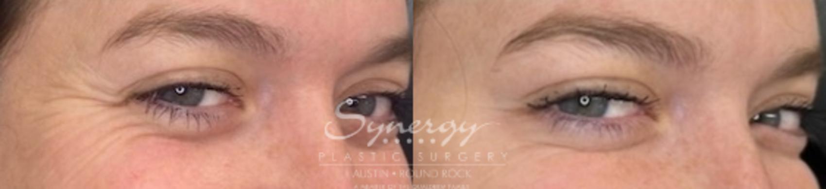 Before & After BOTOX® Cosmetic & Dysport® Case 843 Left Oblique View in Austin, TX