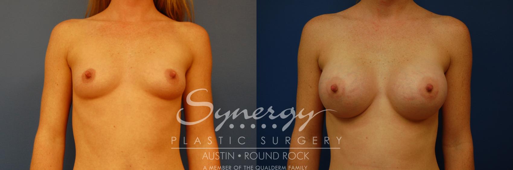 Before & After Breast Augmentation Case 1 View #1 View in Austin, TX