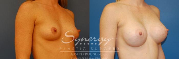 Before & After Breast Augmentation Case 1 View #2 View in Austin, TX