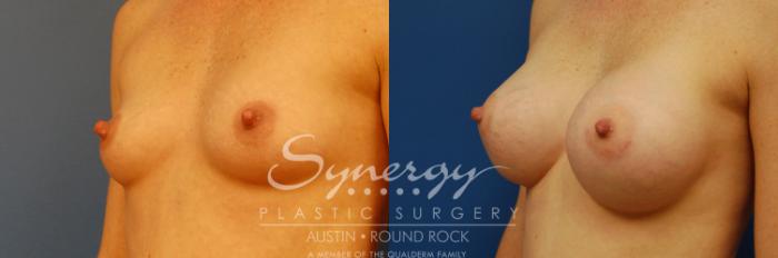 Before & After Breast Augmentation Case 1 View #3 View in Austin, TX