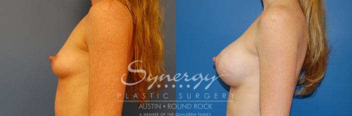 Before & After Breast Augmentation Case 1 View #4 View in Austin, TX