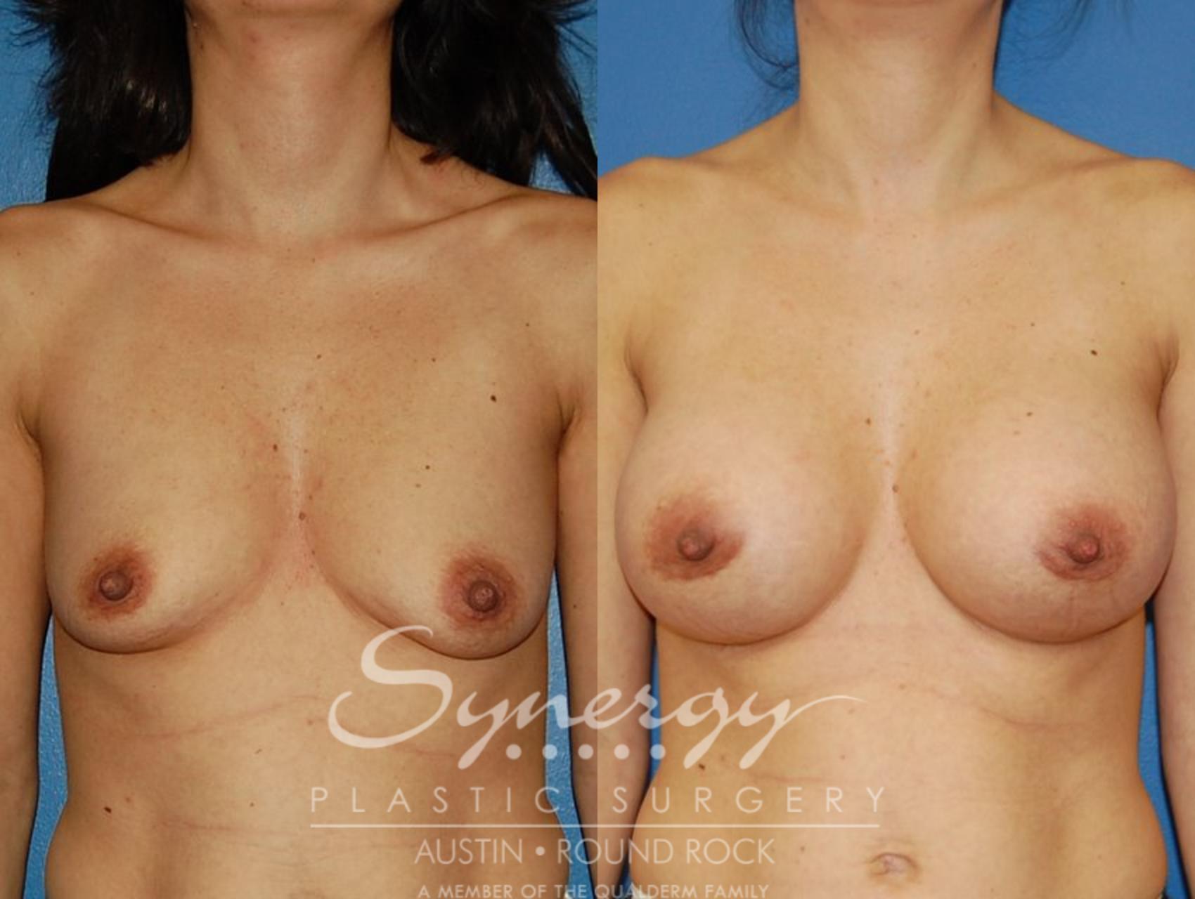 Before & After Breast Augmentation Case 10 View #5 View in Austin, TX