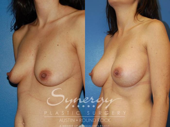Before & After Breast Augmentation Case 10 View #6 View in Austin, TX