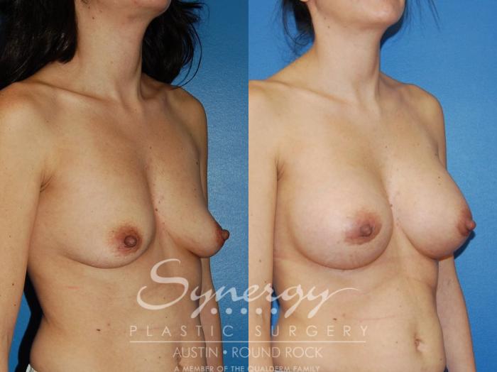 Before & After Breast Augmentation Case 10 View #8 View in Austin, TX