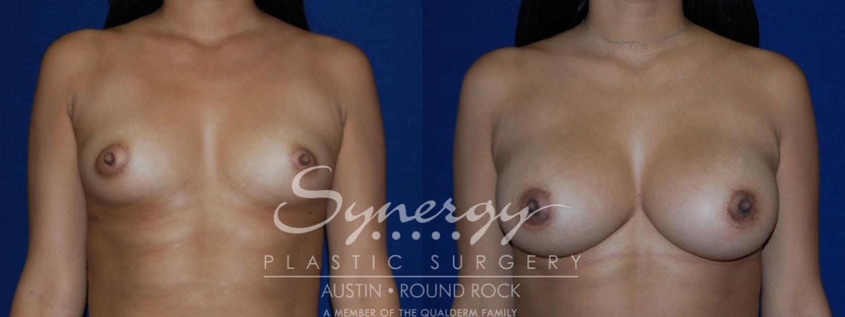Before & After Breast Augmentation Case 100 View #1 View in Austin, TX