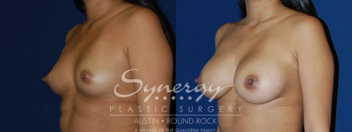 Before & After Breast Augmentation Case 100 View #2 View in Austin, TX